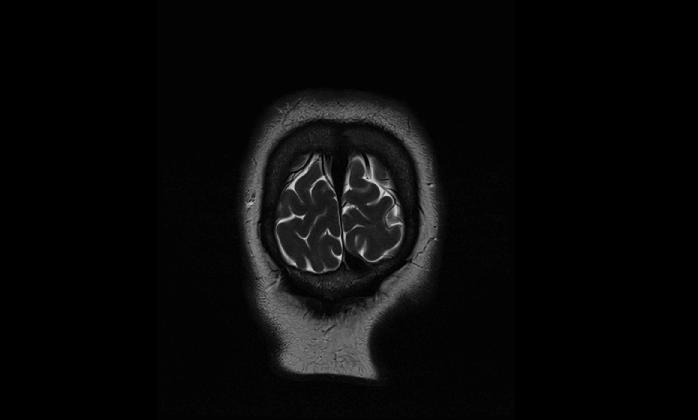 Brain cisterns  and ventricles coronal anatomy 3T MRI image-img-00001-00062.webp